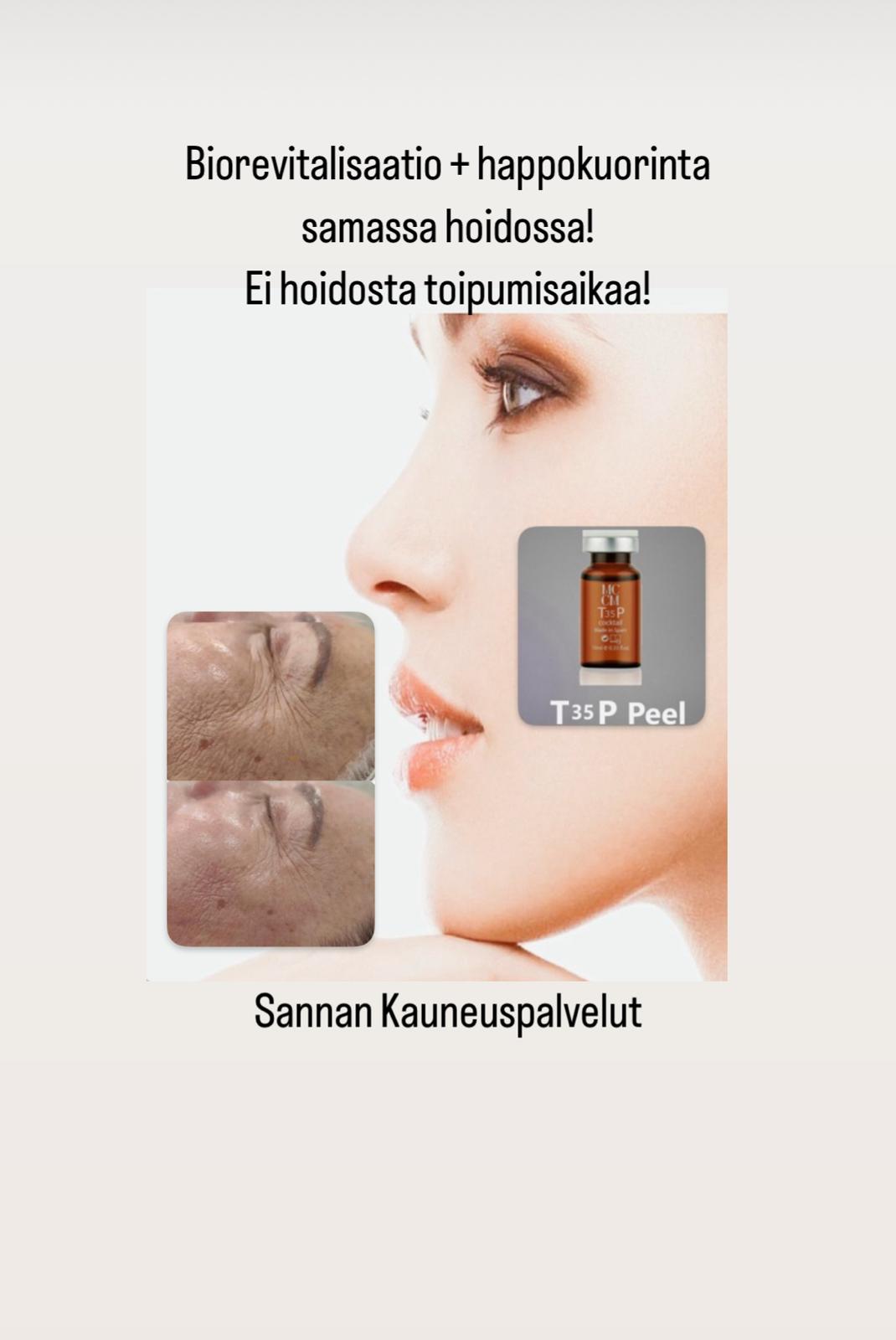 MCCM T35P – biorevitalisaatio ja happokuorinta samassa hoidossa