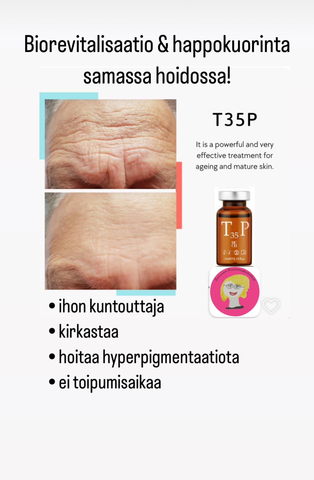 MCCM T35P -hoidon tulokset – ennen ja jälkeen